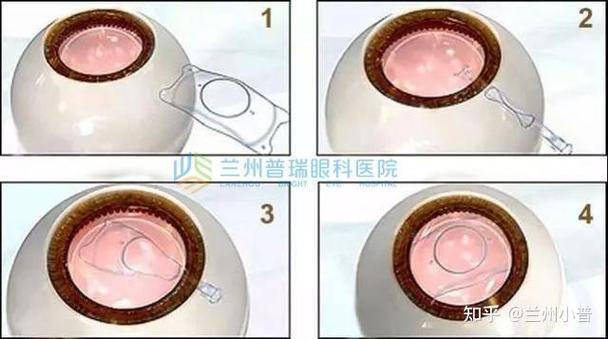 人工晶体植入能用多少年