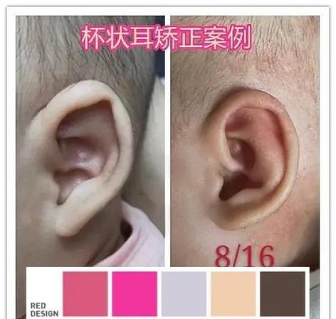 耳朵畸形整形价格