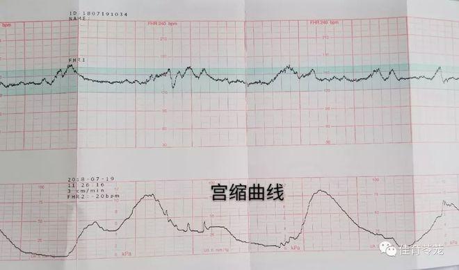 胎心监护NST与CST的区别截图2