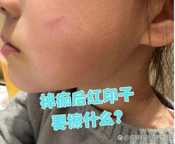激光祛斑掉痂后有红印子怎么办截图1