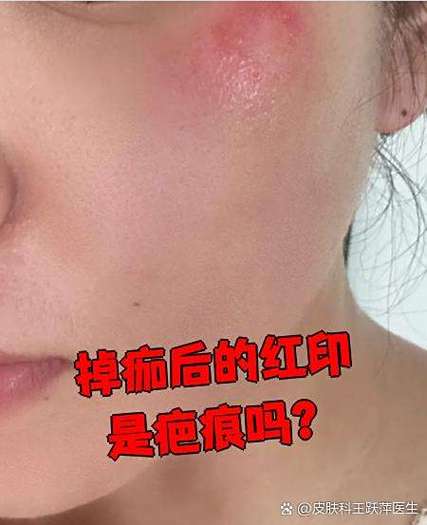 激光祛斑掉痂后有红印子怎么办截图3