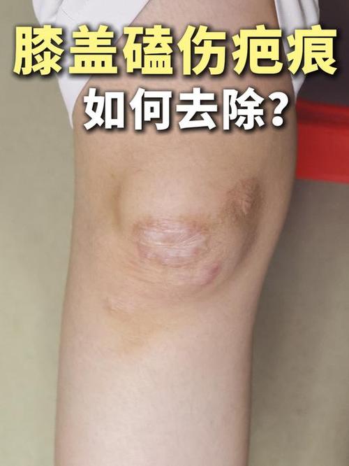 腿上有疤痕怎么去除截图2