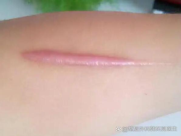 腿上有疤痕怎么去除截图3