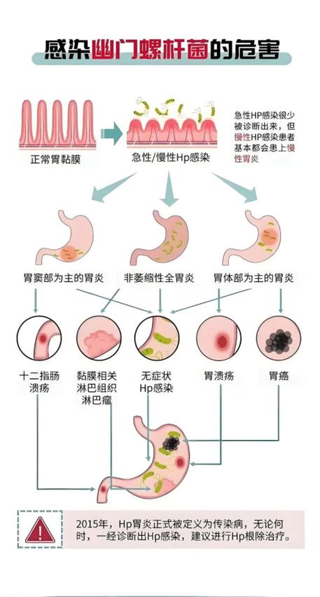 幽门螺杆菌的危害