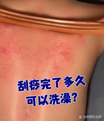 刮痧了可以洗澡么截图3