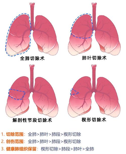 肺部肿瘤治疗方法截图2
