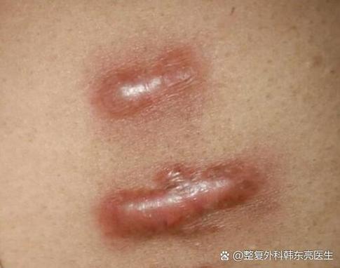 疤痕怎么恢复正常肤色