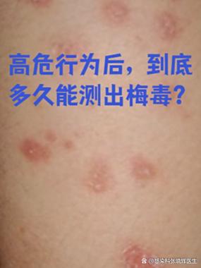 几种行为没必要恐梅毒