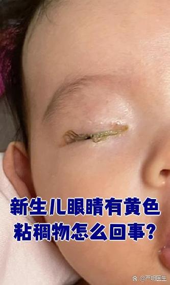 小孩眼睛流眼水