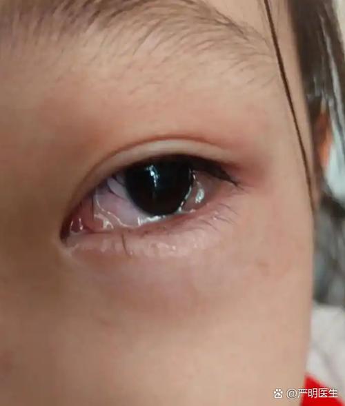 小孩眼睛流眼水截图2