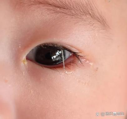 小孩眼睛流眼水截图3