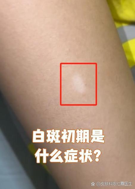 皮肤出现小白斑点是怎么回事
