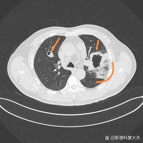 肺部有肿瘤怎么办
