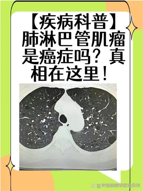 肺部有肿瘤怎么办截图2