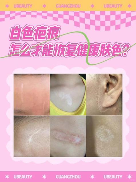 疤痕多久恢复正常肤色加速永久